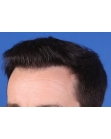 After Hair Transplant&nbsp;Hairlines